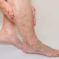 Reliable Varicose Veins Treatment in Jaipur