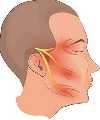 Ease The Pain With The Trigeminal Neuralgia Treatment In Jaipur